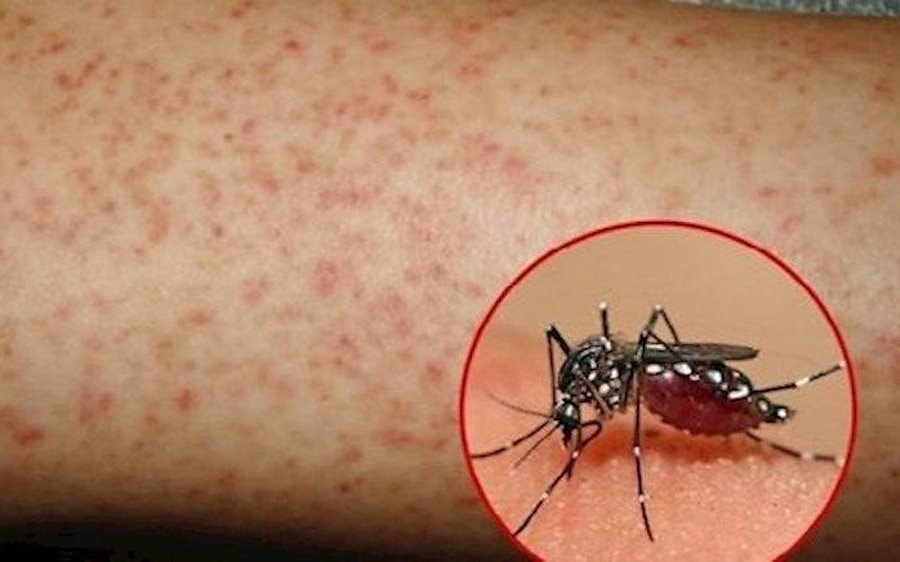 Muỗi vằn là tác nhân gây ra bệnh sốt xuất huyết vô cùng nguy hiểm